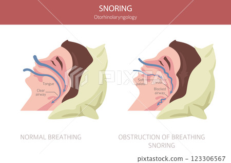 Snoring diseases. Obstructive sleep apnea. Sleep related breathing disorder. Medical infographic design Snoring diseases. Obstructive sleep apnea. Sleep related breathing disorder. Medical infographic design 123306567