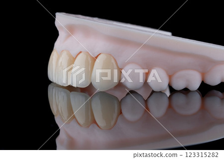 Side view of six dental crowns made of zirconium for fixation to the frontal teeth of upper jaw. 123315282