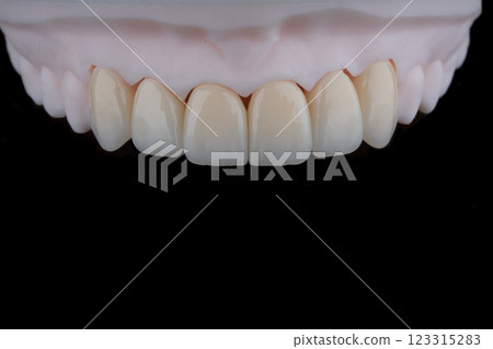 High-quality six dental crowns made of zirconium for fixation to the frontal teeth of upper jaw. High-quality six dental crowns made of zirconium for fixation to the frontal teeth of upper jaw. 123315283