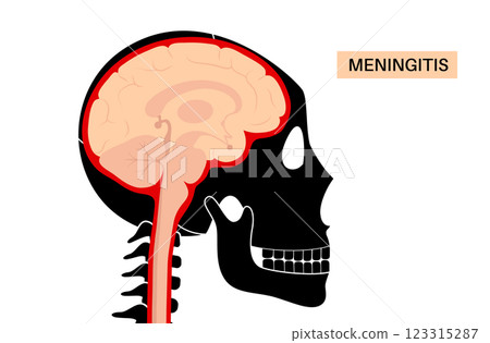 Meningitis medical poster 123315287