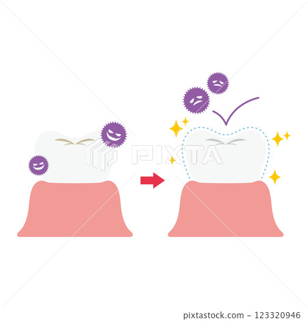 為防止色素沉澱和蛀牙而塗有塗層的牙齒圖示 123320946