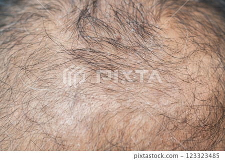 Cropped shot view of bald spot on Asian men's head with dandruff problem. Dandruff is a common condition that causes the skin on the scalp to flake. Cropped shot view of bald spot on Asian men's head with dandruff problem. Dandruff is a common condition that causes the skin on the scalp to flake. 123323485