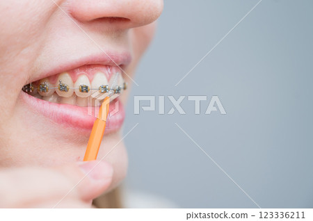 Unrecognizable Caucasian woman cleans braces with a brush. Close-up of female teeth with brackets Unrecognizable Caucasian woman cleans braces with a brush. Close-up of female teeth with brackets 123336211