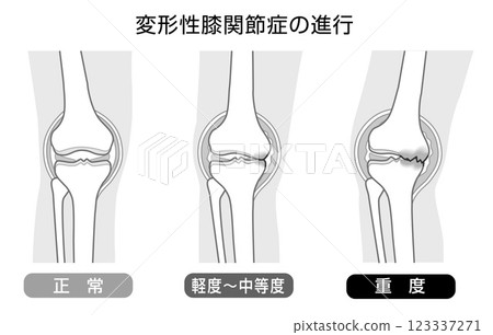 Monotone illustration showing the progression of knee osteoarthritis 123337271