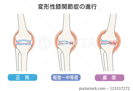 Illustration showing the progression of knee osteoarthritis 123337272