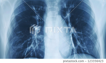 Chest X-ray Representation Showing Pneumonia with a Clear Contrast Between Healthy Lung Tissue and Areas Affected by Infection 123356423