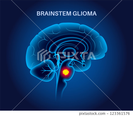 Brainstem glioma cancer 123361576