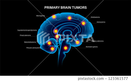 Primary brain tumors Primary brain tumors 123361577