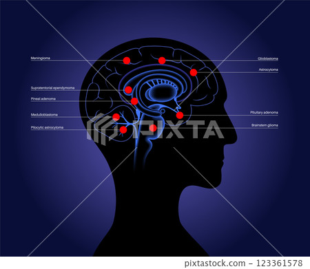 Primary brain tumors 123361578