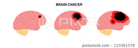 Brain cancer grade Brain cancer grade 123361579