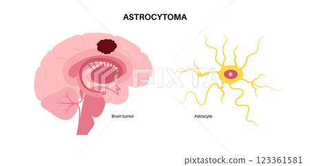 Astrocytoma brain cancer 123361581