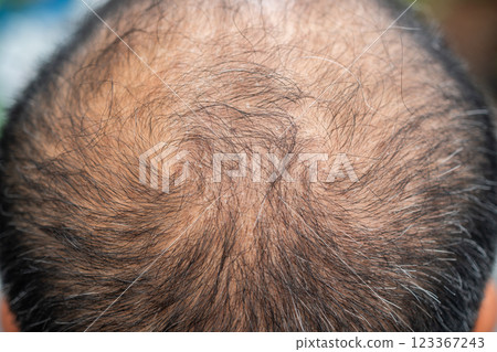 Cropped shot view of bald spot on Asian men's head with thin hair and white hair appear. Cropped shot view of bald spot on Asian men's head with thin hair and white hair appear. 123367243