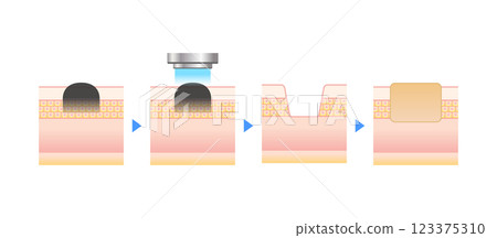 Vector illustration of cross section of skin being irradiated with laser Vector illustration of cross section of skin being irradiated with laser 123375310