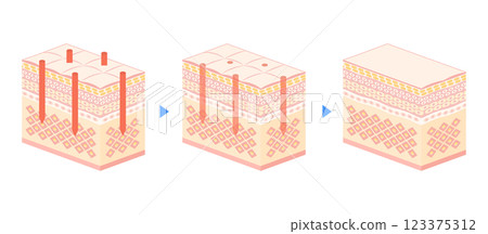 Vector illustration of cross section of skin being irradiated with laser Vector illustration of cross section of skin being irradiated with laser 123375312