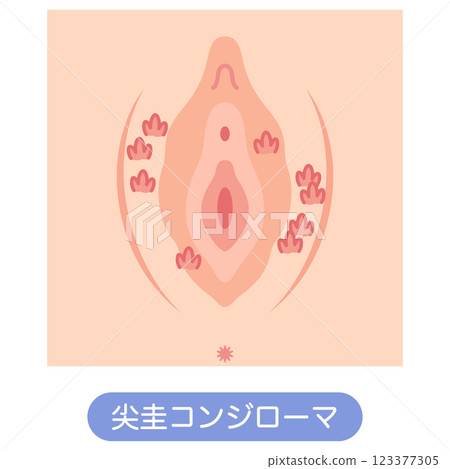 女性外生殖器疾病：生殖器疣 123377305