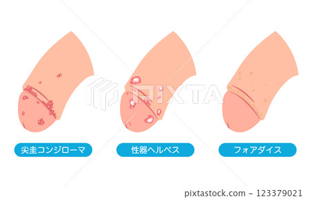 男性生殖器上的腫塊－性傳染病的類型 123379021