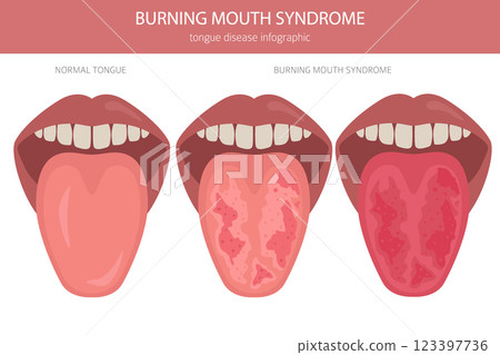 Burning mouth syndrome diseases. Oral medisine. Medical infographic design 123397736