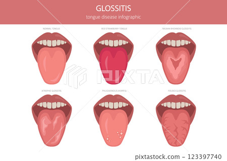 Glossitis tongue disease. Oral medicine. Medical infographic design 123397740