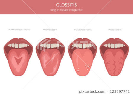Glossitis tongue disease. Oral medicine. Medical infographic design 123397741