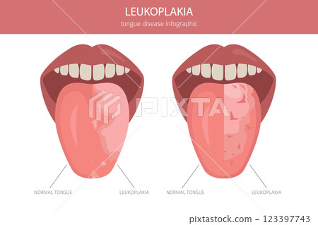 Leukoplakia tongue disease. Oral medicine. Medical infographic design 123397743
