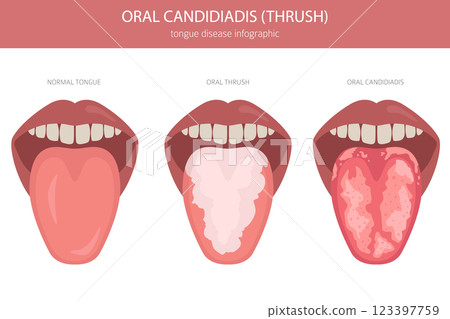 Oral thrush. Oral candidiadis disease. Medical infographic design 123397759