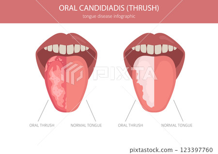 Oral thrush. Oral candidiadis disease. Medical infographic design 123397760