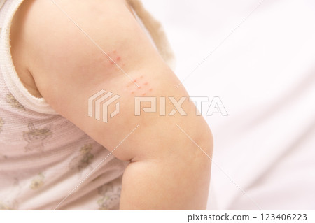 [Baby's arm after BCG vaccination] 123406223