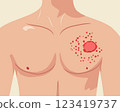 Medical illustration of a human chest with a skin rash, redness, and inflammation. Symptoms of skin infection, allergic reaction, or dermatological disease 123419737