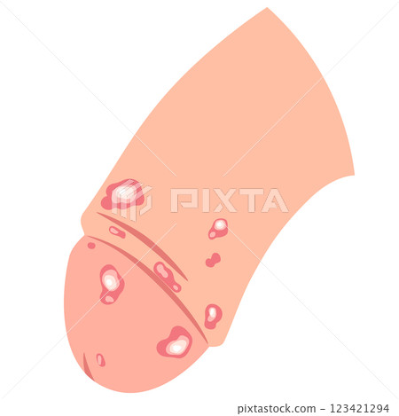Genital herpes: Bumps on the male genitals Genital herpes: Bumps on the male genitals 123421294