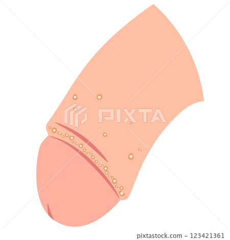 Fordyce spots: bumps on the male genitals Fordyce spots: bumps on the male genitals 123421361