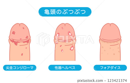 Bumps on male genitals - types of sexually transmitted diseases Bumps on male genitals - types of sexually transmitted diseases 123421374