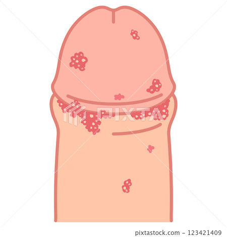 Genital warts: Bumps on the male genitals Genital warts: Bumps on the male genitals 123421409