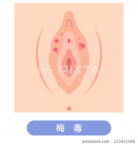 Diseases of the female external genitalia: Syphilis 123421589