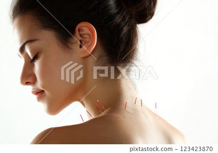 Holistic wellness: ancient practice of acupuncture, delicate placement of needles on the human body, emphasizing balance, healing, and the therapeutic benefits of this traditional method. Holistic wellness: ancient practice of acupuncture, delicate placement of needles on the human body, emphasizing balance, healing, and the therapeutic benefits of this traditional method. 123423870