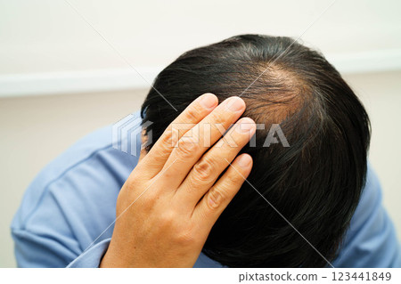 Bald head in man, hair loss treatment health problem. Bald head in man, hair loss treatment health problem. 123441849