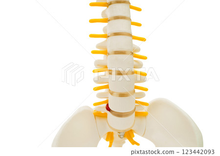 Spinal nerve and bone, Lumbar spine displaced herniated disc fragment, Model for treatment medical in the orthopedic department. Spinal nerve and bone, Lumbar spine displaced herniated disc fragment, Model for treatment medical in the orthopedic department. 123442093