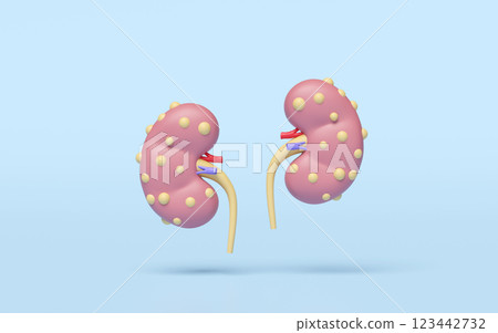 3d Chronic kidney disease or CKD isolated on blue background. world kidney day concept, 3d illustration render 3d Chronic kidney disease or CKD isolated on blue background. world kidney day concept, 3d illustration render 123442732