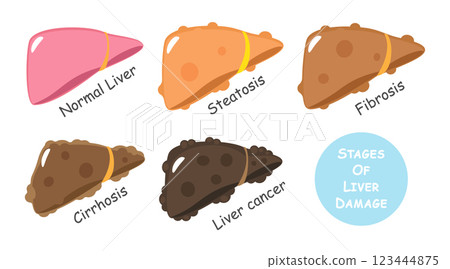 Stages of liver damage include steatosis or fatty liver, fibrosis, cirrhosis and cancer or hepatocellular carcinoma . Flat design . Vector . 123444875