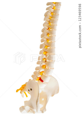 Spinal nerve and bone, Lumbar spine displaced herniated disc fragment, Model for treatment medical in the orthopedic department. Spinal nerve and bone, Lumbar spine displaced herniated disc fragment, Model for treatment medical in the orthopedic department. 123469598