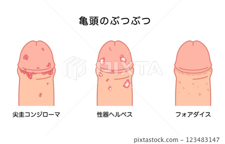 男性生殖器上的腫塊－性傳染病的類型 123483147