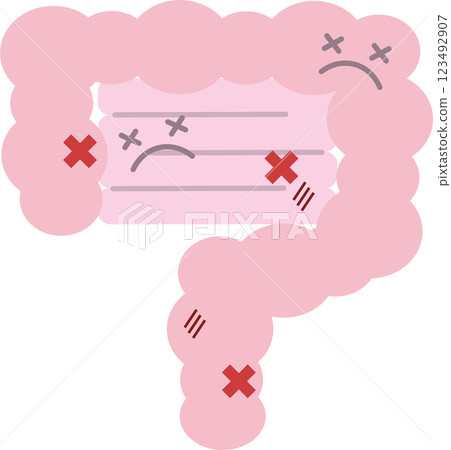 Illustration of an unhealthy and damaged small and large intestine Illustration of an unhealthy and damaged small and large intestine 123492907