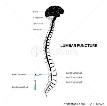 Lumbar puncture spinal tap Lumbar puncture spinal tap 123518524