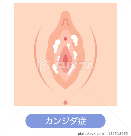 Diseases of the female external genitalia: Candidiasis 123518985