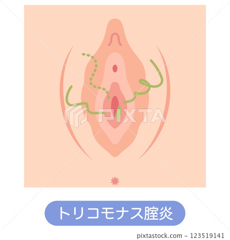 女性外生殖器疾病：滴蟲性陰道炎 123519141