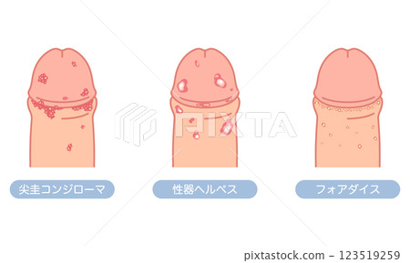 Bumps on male genitals - types of sexually transmitted diseases 123519259