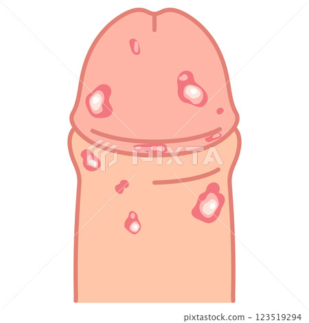 Genital herpes: Bumps on the male genitals 123519294