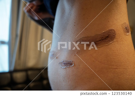 手術後疤痕進展-腹部皮膚再生和疤痕護理的醫學影像 123530140
