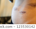 Scar progression after surgery - medical image of abdominal skin regeneration and scar care 123530142