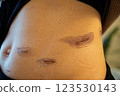 Scar progression after surgery - medical image of abdominal skin regeneration and scar care 123530143