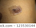 Scar progression after surgery - medical image of abdominal skin regeneration and scar care 123530144